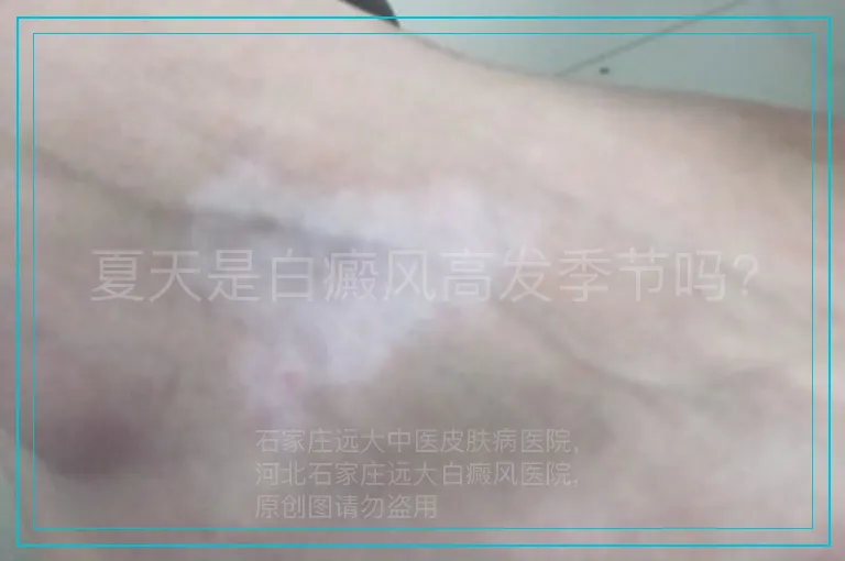 夏天是白癜风高发季节吗?