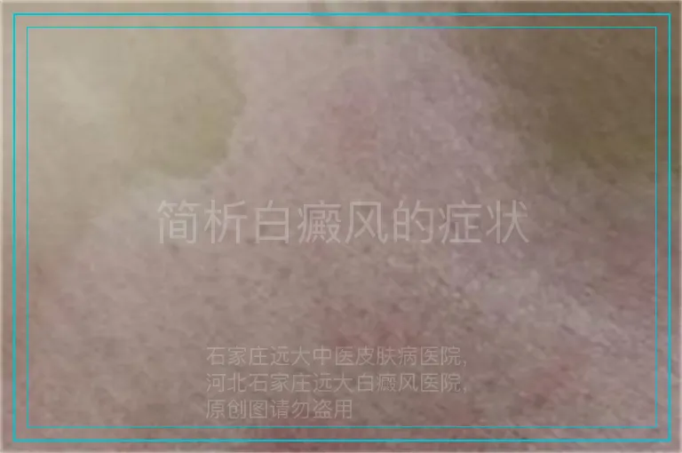 简析白癜风的症状