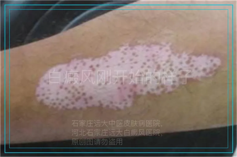 白癜风刚开始的样子