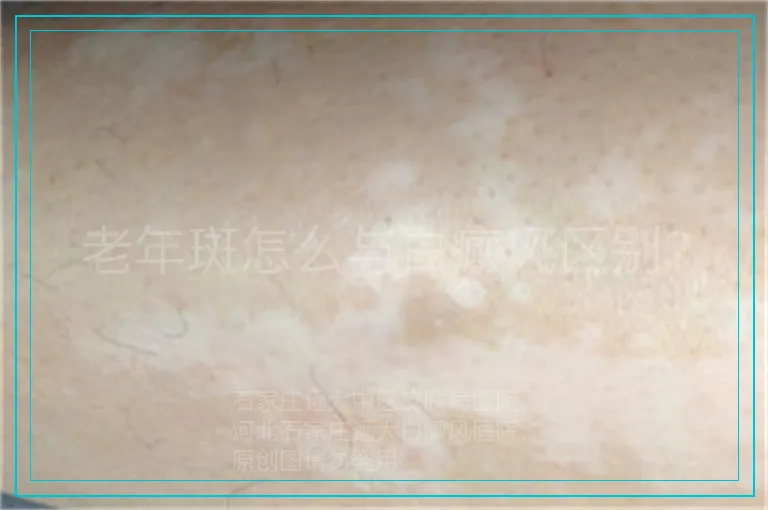 老年斑怎么与白癜风区别?