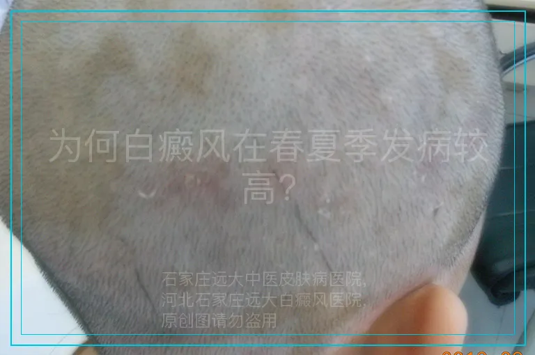 为何白癜风在春夏季发病较高?