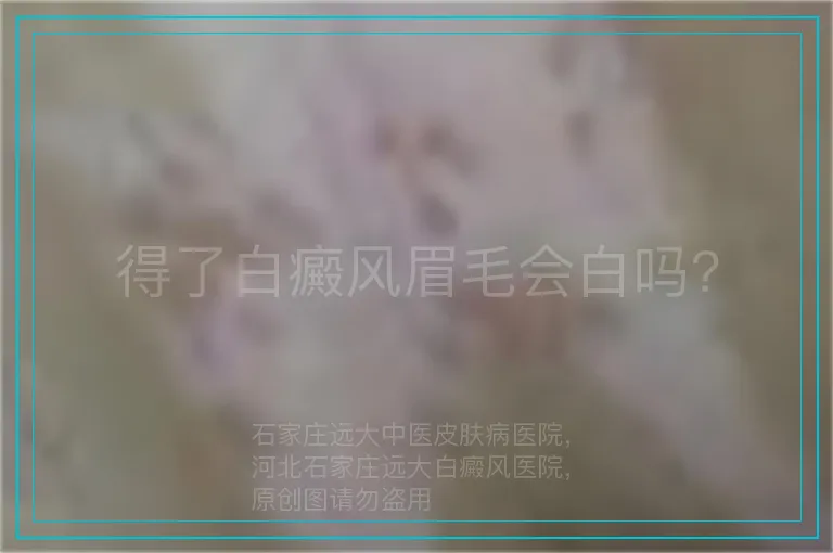 得了白癜风眉毛会白吗?