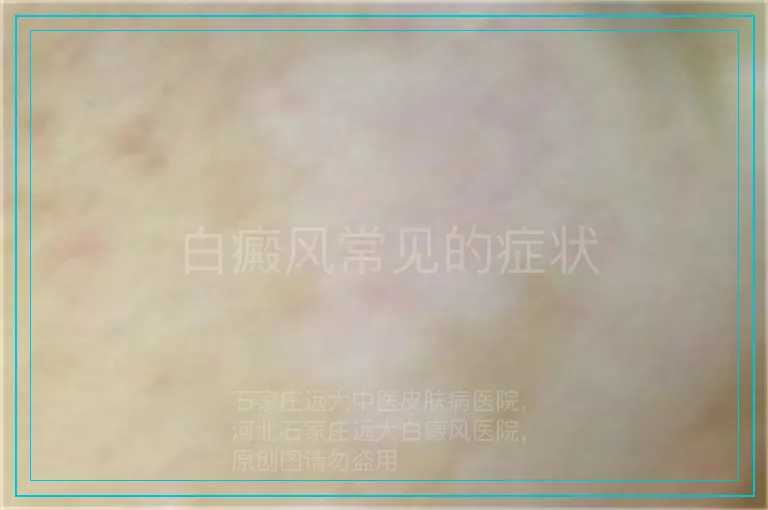 白癜风常见的症状