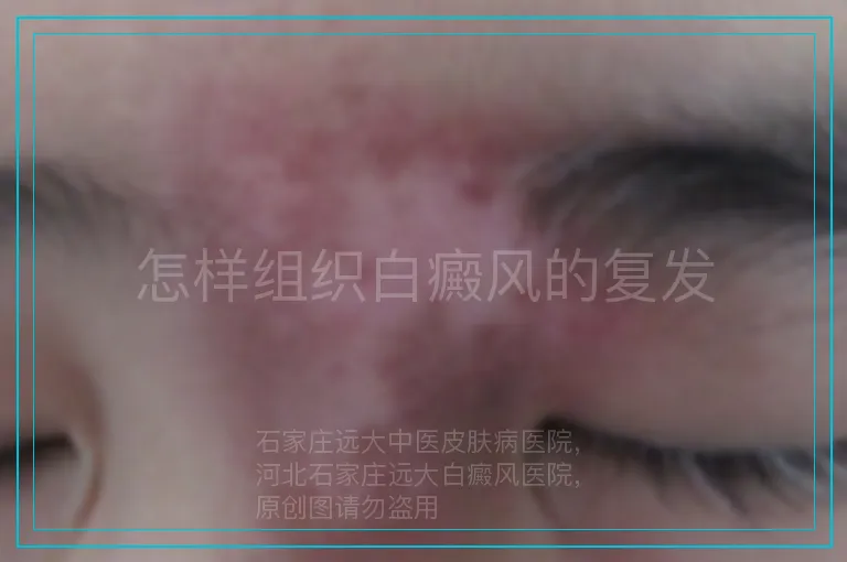 怎样组织白癜风的复发