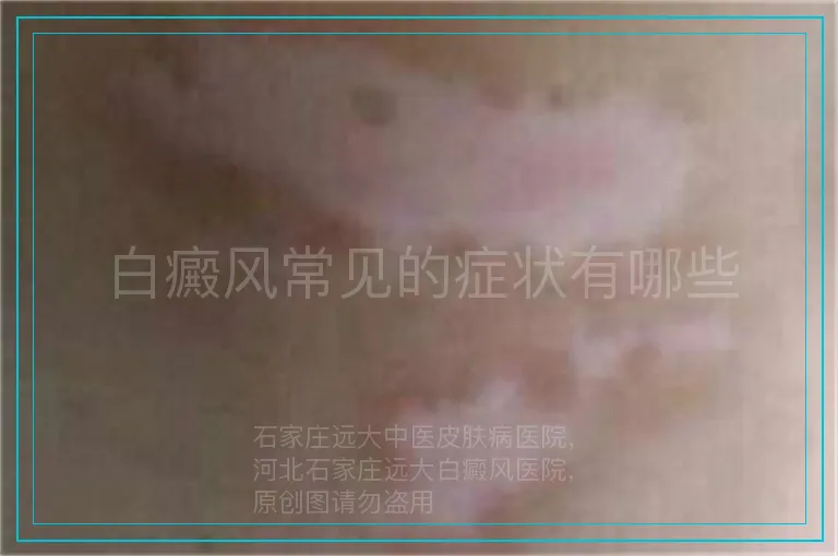 白癜风常见的症状有哪些
