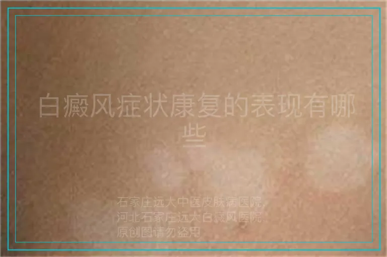 白癜风症状康复的表现有哪些
