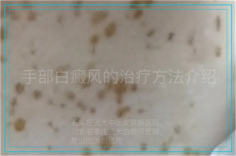 手部白癜风的治疗方法介绍