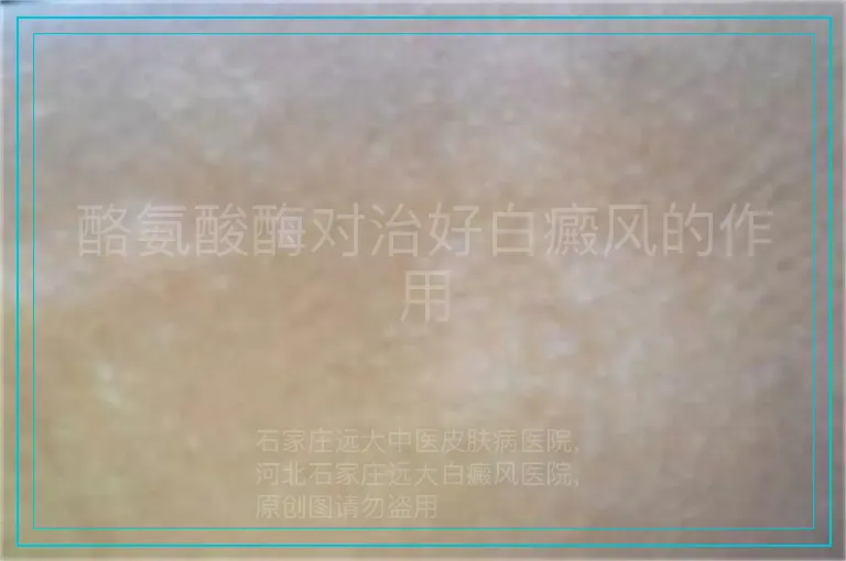 酪氨酸酶对治好白癜风的作用