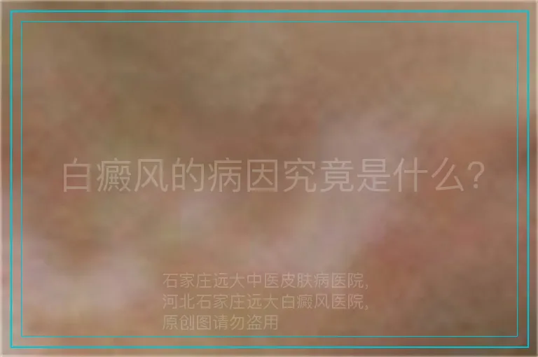 白癜风的病因究竟是什么？