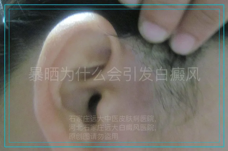 暴晒为什么会引发白癜风