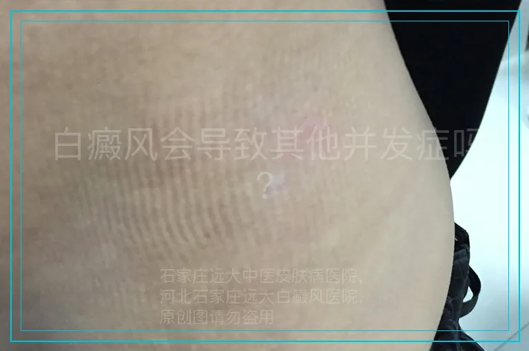 白癜风会导致其他并发症吗？