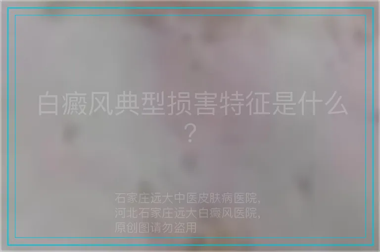 白癜风典型损害特征是什么？