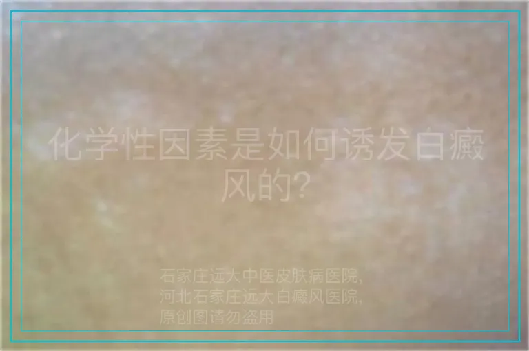 化学性因素是如何诱发白癜风的？
