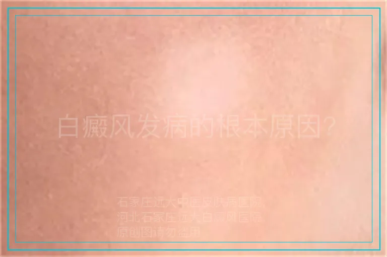 白癜风发病的根本原因?