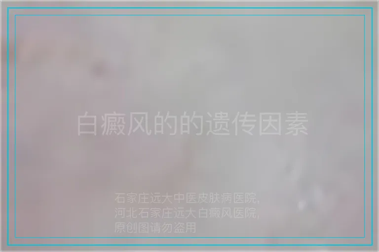 白癜风的的遗传因素