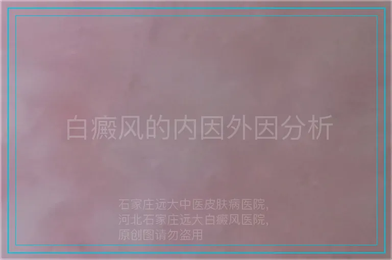 白癜风的内因外因分析