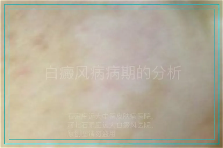 白癜风病病期的分析