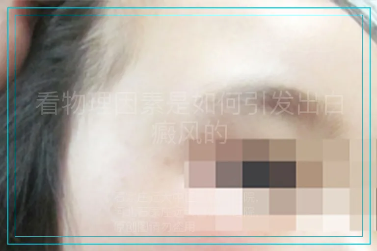 看物理因素是如何引发出白癜风的