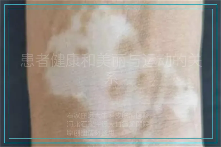 患者健康和美丽与运动的关系