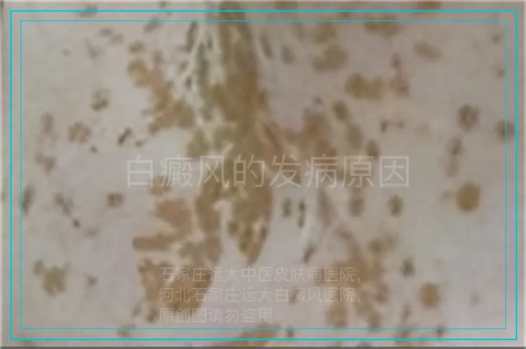 白癜风的发病原因
