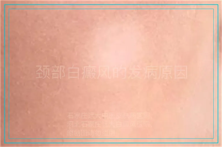 颈部白癜风的发病原因