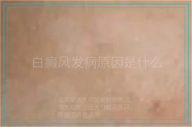 白癜风发病原因是什么