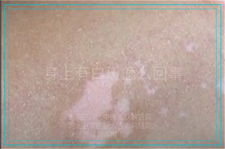 身上有白斑怎么回事