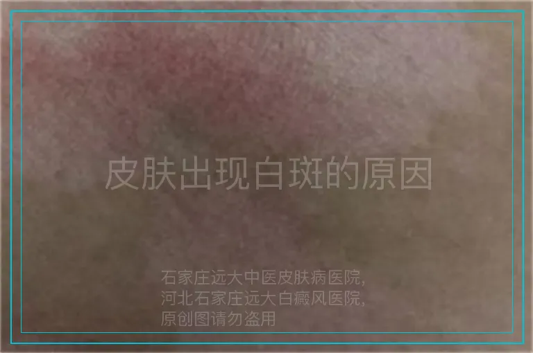 皮肤出现白斑的原因