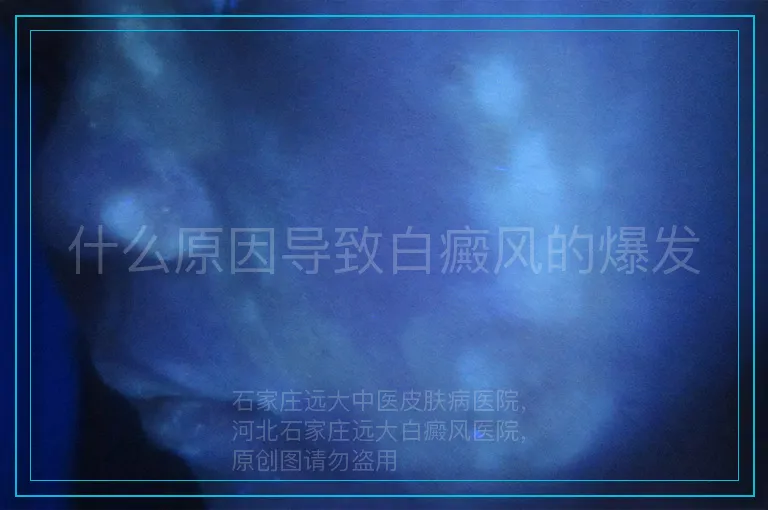 什么原因导致白癜风的爆发