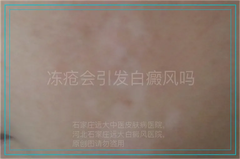 冻疮会引发白癜风吗
