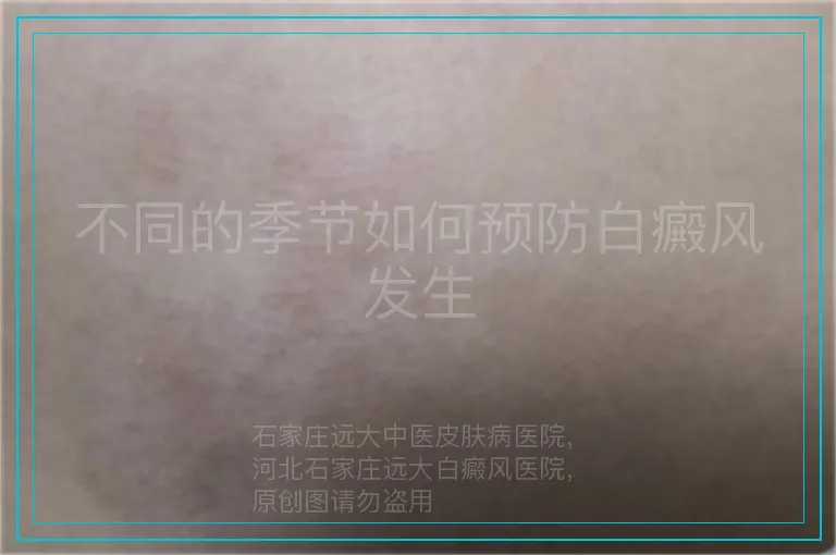 不同的季节如何预防白癜风发生