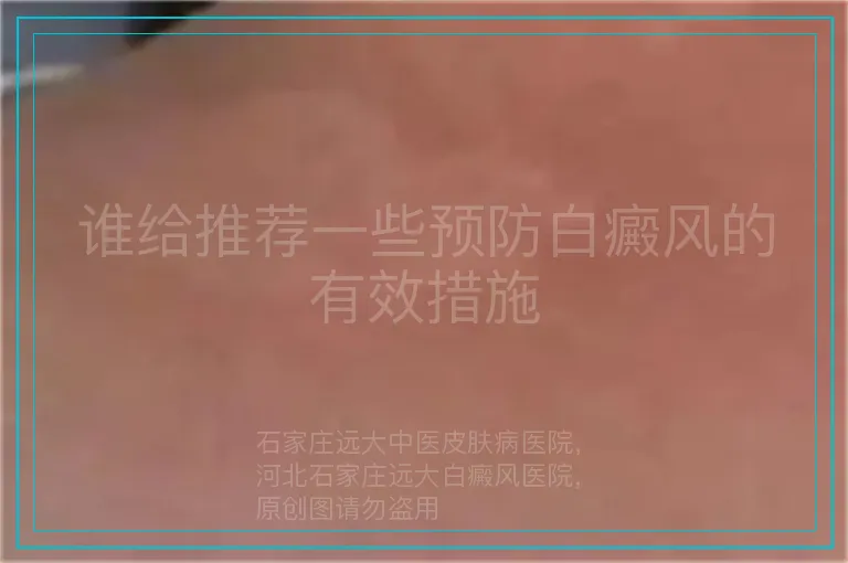 谁给推荐一些预防白癜风的有效措施