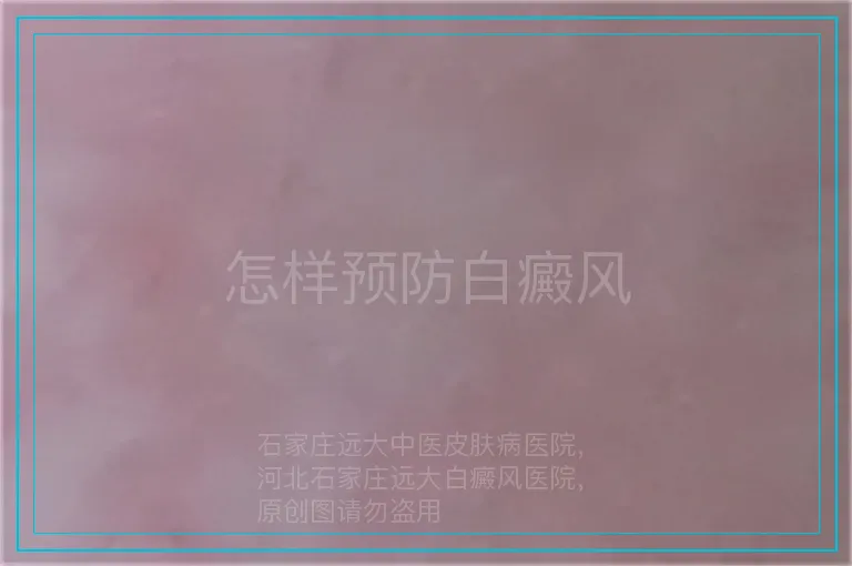 怎样预防白癜风