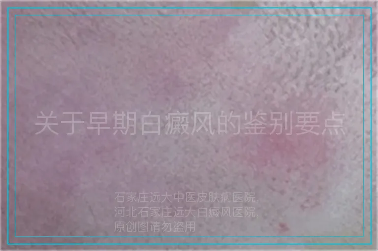关于早期白癜风的鉴别要点