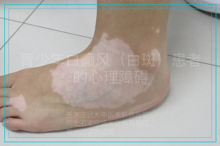 青少年白癜风（白斑）患者的心理障碍