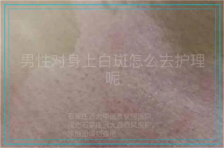男性对身上白斑怎么去护理呢