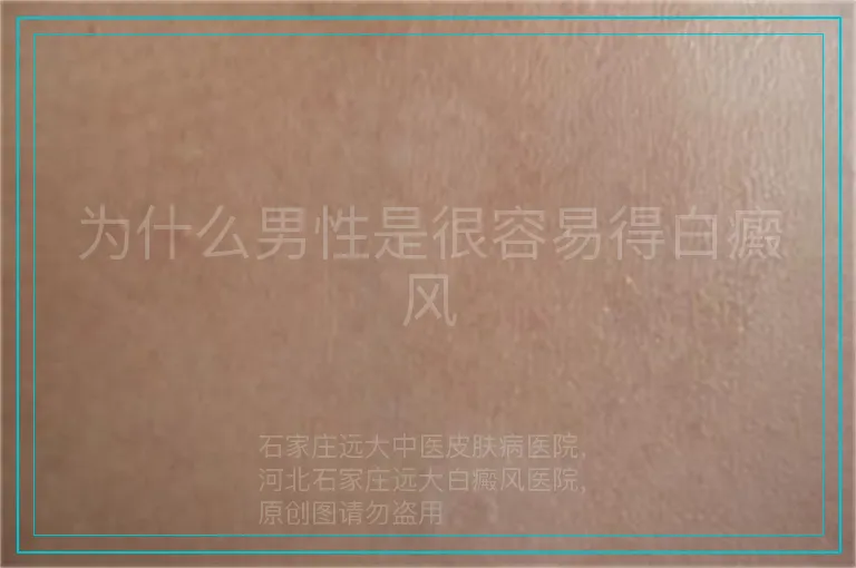 为什么男性是很容易得白癜风