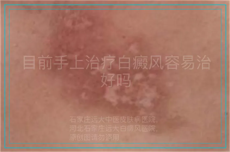 目前手上治疗白癜风容易治好吗