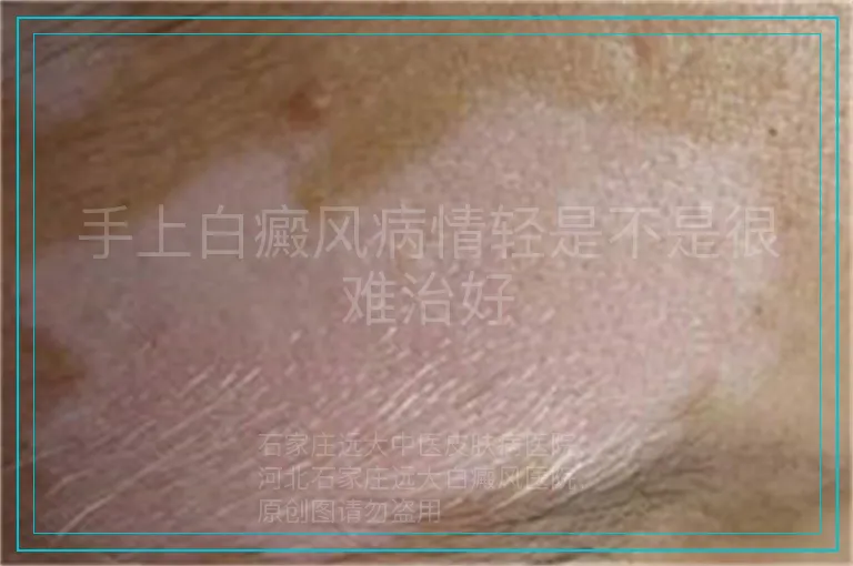 手上白癜风病情轻是不是很难治好