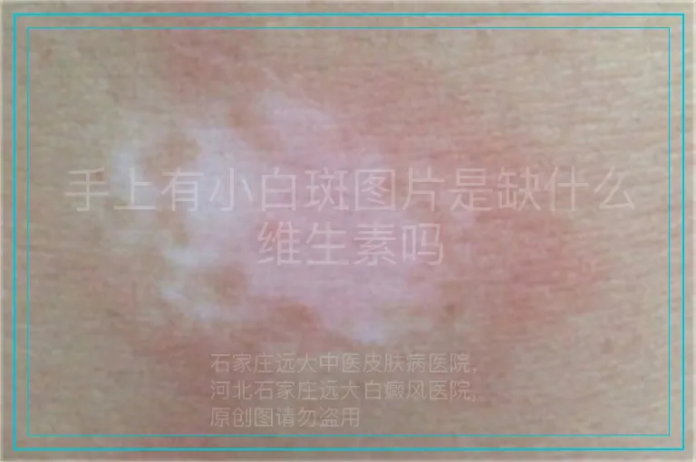 手上有小白斑图片是缺什么维生素吗