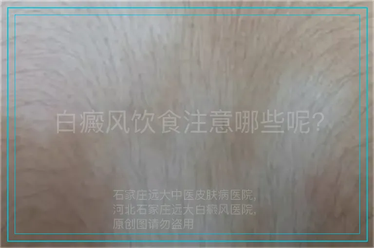 白癜风饮食注意哪些呢?