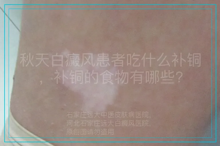 秋天白癜风患者吃什么补铜，补铜的食物有哪些?