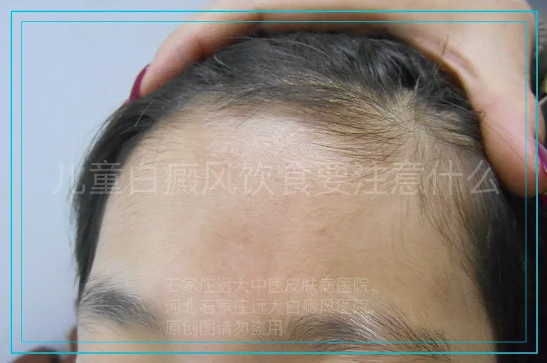 儿童白癜风饮食要注意什么