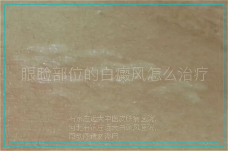 眼睑部位的白癜风怎么治疗