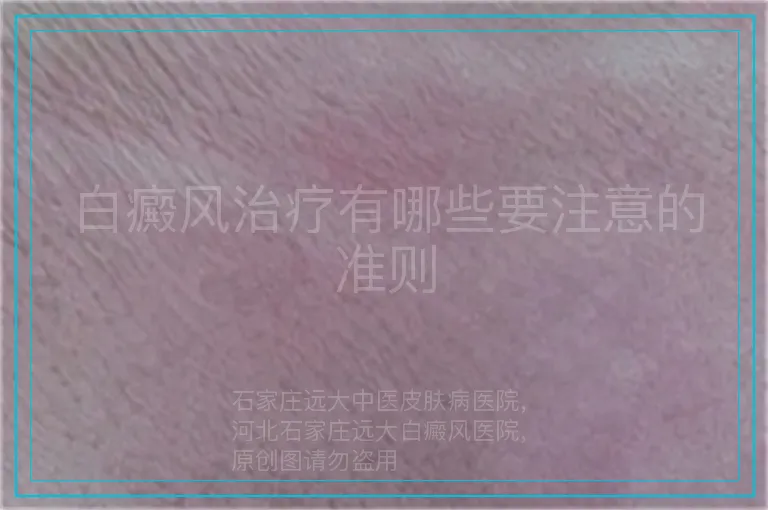 白癜风治疗有哪些要注意的准则