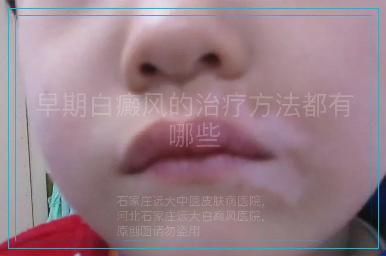 早期白癜风的治疗方法都有哪些