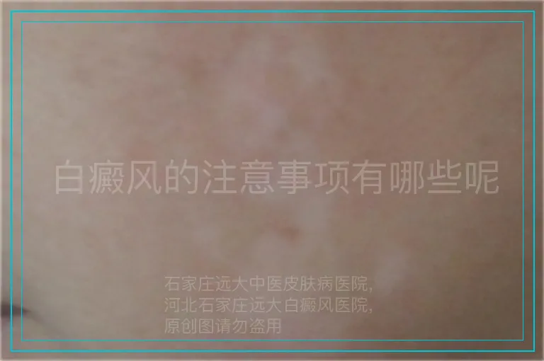 白癜风的注意事项有哪些呢