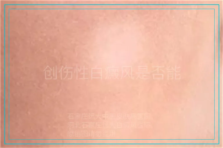 创伤性白癜风是否能