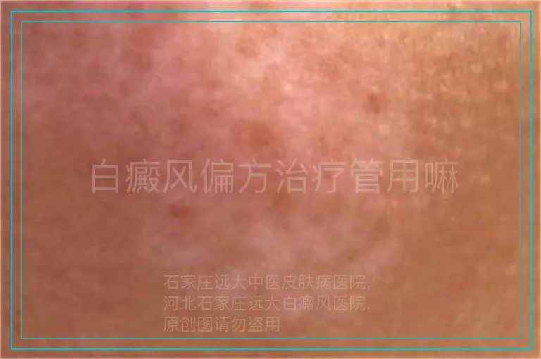 白癜风偏方治疗管用嘛