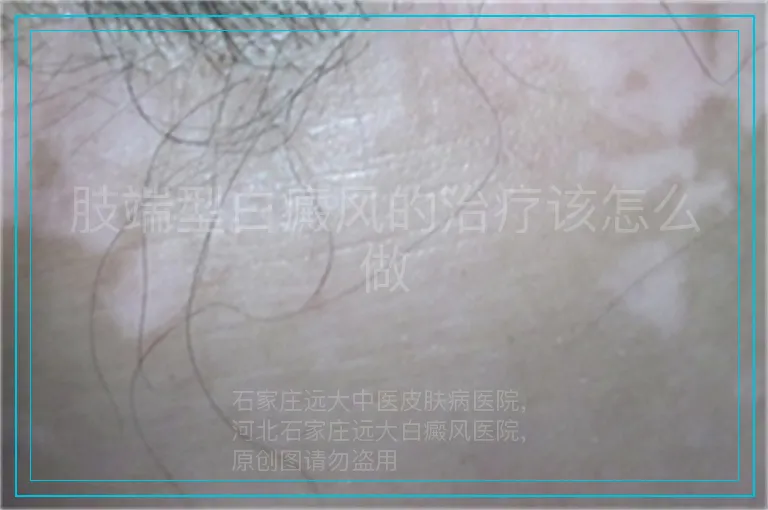 肢端型白癜风的治疗该怎么做